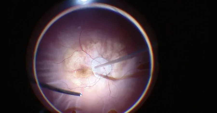 Retina Micro Surgery